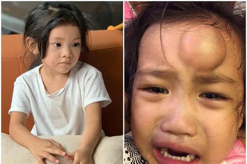 Con gái Hải Băng bị cào rách mặt vì ẩu đả, con Ốc Thanh Vân tai nạn còn xót hơn