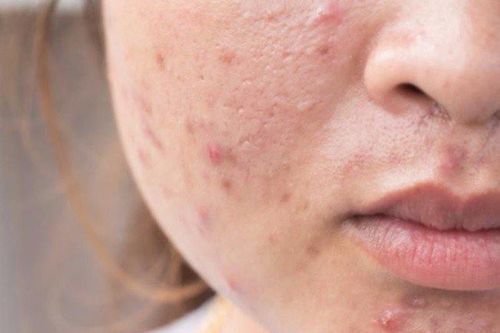 Cách điều trị mụn trứng cá, nám da