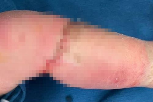 Bé trai mắc hội chứng vòng thắt bẩm sinh hiếm gặp
