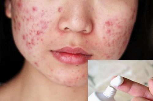 Lạm dụng thuốc bôi trị mụn, mụn càng nhiều hơn