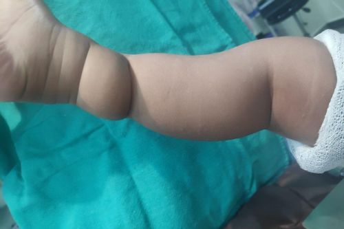 Triệu chứng bệnh ở trẻ có thể bị lầm tưởng là ngấn tay chân