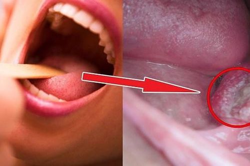 Bệnh ung thư vòm họng nên và không nên ăn gì?