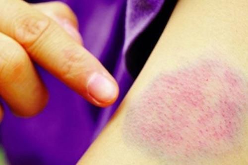 Thấy dấu hiệu này trên da hãy đi khám ngay kẻo hối chẳng kịp