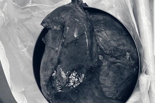 Người phụ nữ mang khối u hiếm nặng tới 2,2kg nhưng lầm tưởng mình béo bụng