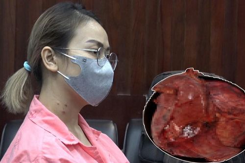 Cố nịt bụng vì sợ bị chê mập, không ngờ mang khối u tụy lớn nhất thế giới