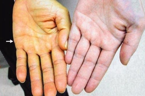 Dấu hiệu cảnh báo gan đang kêu cứu