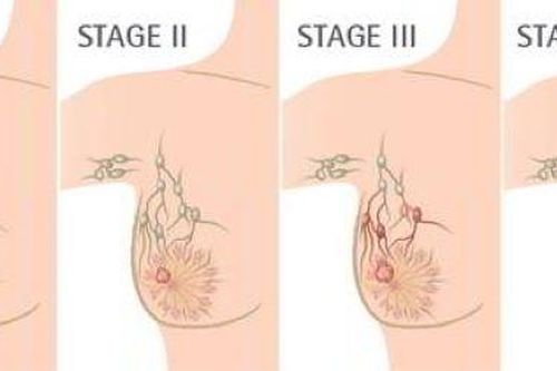 Phối hợp phẫu thuật và xạ trị cho bệnh nhân ung thư biểu mô tuyến vú không xâm lấn