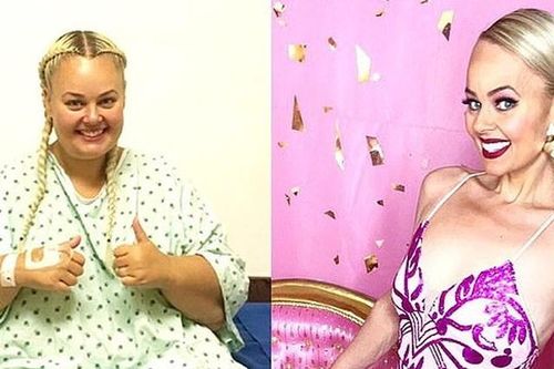 Người phụ nữ quyết cắt bỏ 80% dạ dày, giảm 90 kg để giống búp bê Barbie