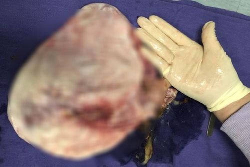 Hơn 1 giờ phẫu thuật bóc tách khối u buồng trứng 'khủng' cho nữ sinh 16 tuổi