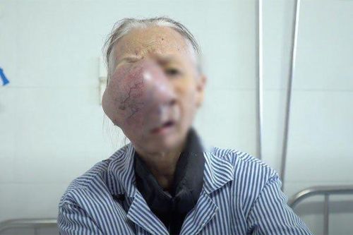 Cụ bà nghèo với khối u trên mặt to như trái bưởi