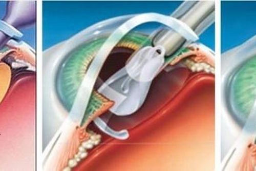 Kính nội nhãn - Lựa chọn nào khi phẫu thuật phaco ?