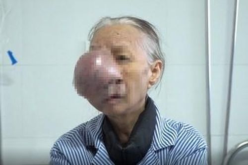 Phẫu thuật thành công khối u che nửa mặt cụ bà