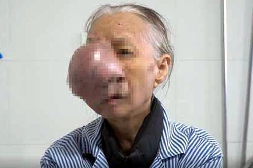 Người phụ nữ bị khối u khổng lồ hiếm gặp che kín nửa mặt