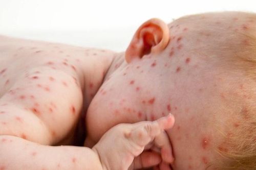 Thủy đậu và zona: Một nguyên nhân hai căn bệnh