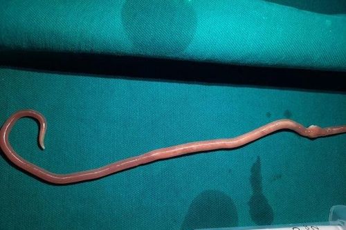Giun đũa dài 25cm chui trong ống mật của bệnh nhân 31 tuổi