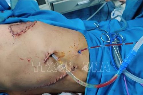 Phẫu thuật thành công trường hợp u thành ngực xâm lấn rộng