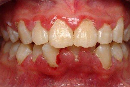 Muốn khỏe răng, tránh xa thuốc lá điện tử