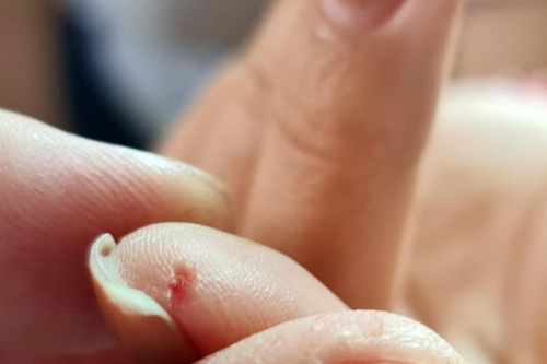 Người phụ nữ bị chuột cắn chảy máu tay