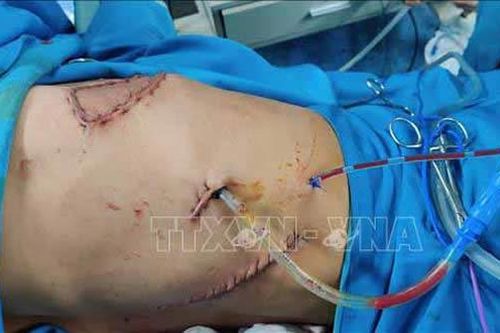 Phẫu thuật thành công trường hợp u thành ngực xâm lấn rộng