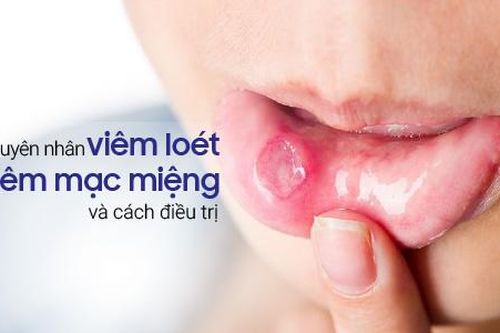 Viêm loét niêm mạc miệng sẽ không còn đáng sợ nếu biết cách