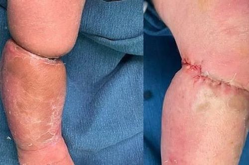 Mắc bệnh hiếm nguy hiểm rất dễ nhầm với ngấn ở trẻ em, bé trai 9 ngày tuổi đã phải nhập viện phẫu thuật