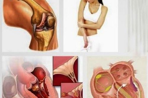 Hiểu đúng về bệnh thấp khớp cấp