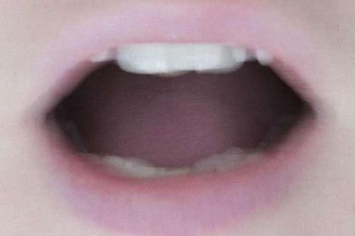 Phát hiện triệu chứng mới có thể là dấu hiệu của Covid-19