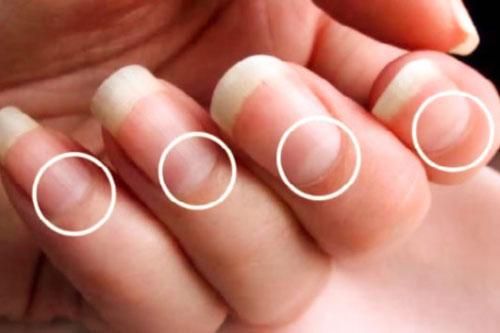 Những dấu hiệu bất thường từ móng tay báo hiệu cơ thể có bệnh