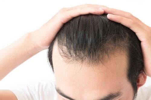 2 cách trị hói đầu tại nhà không tốn kém