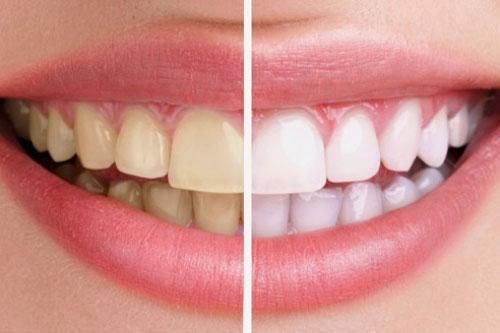 3 công thức tẩy trắng răng tại nhà đơn giản có thể bạn chưa biết