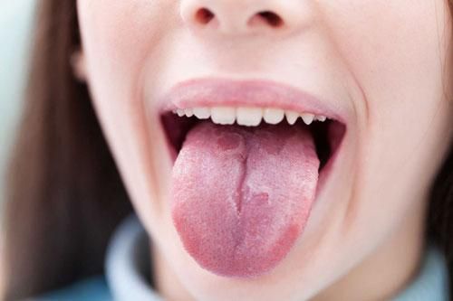 Dấu hiệu ở lưỡi cảnh báo bệnh nguy hiểm