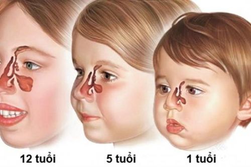 Nguyên nhân gây viêm xoang ở trẻ