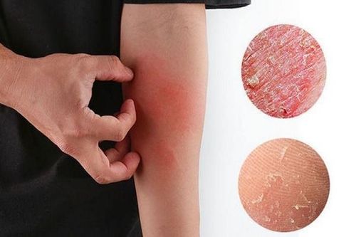 Ngứa da mùa lạnh và cách xử trí