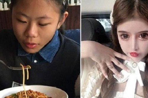 Thiếu nữ 16 tuổi phẫu thuật thẩm mỹ 100 lần trong ba năm