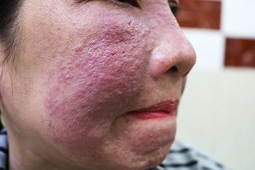 Hiểm họa từ 'mỹ phẩm thảo dược thiên nhiên'