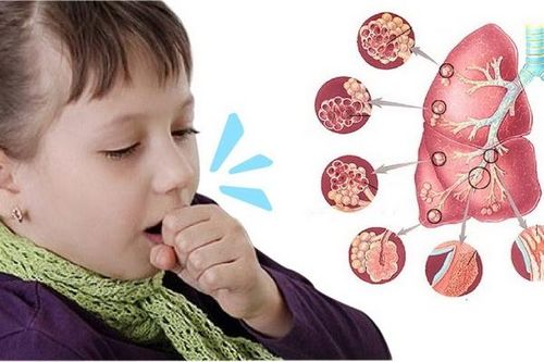 Chứng ho kéo dài gây nhiều khó chịu