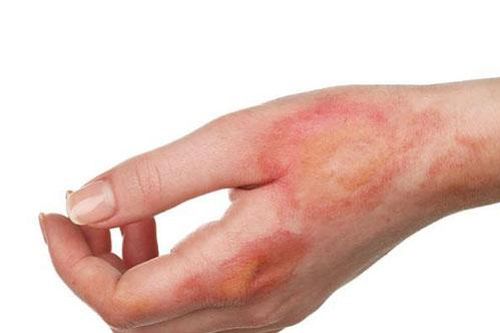 Những cách trị vết bỏng để không bị sẹo