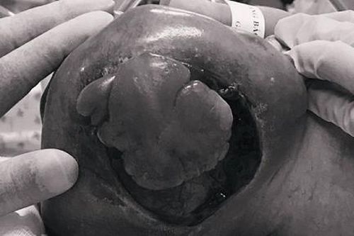 Bé sơ sinh mang khối u quái khổng lồ vùng cùng cụt