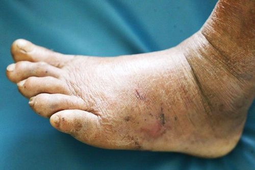 Đi cắt cỏ, cụ ông bị rắn độc cắn nguy kịch