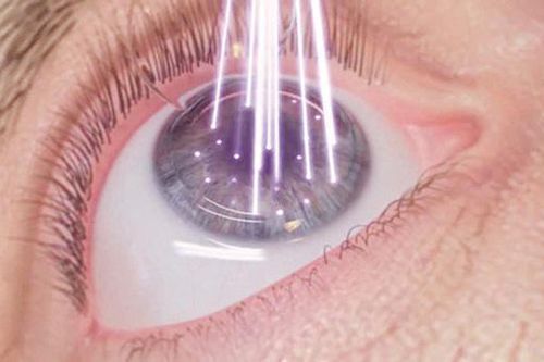 Bệnh nhân cần kiêng gì sau mổ cận thị?