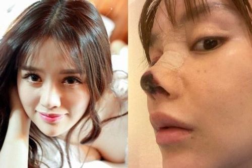 Bi kịch của những cô gái trẻ phẫu thuật thẩm mỹ hỏng