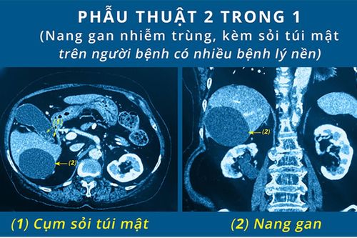 Cứu sống cụ bà 85 tuổi nhiễm trùng nang gan, sỏi túi mật