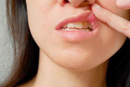 Tổn thương miệng, lòng bàn tay - triệu chứng mới của COVID-19