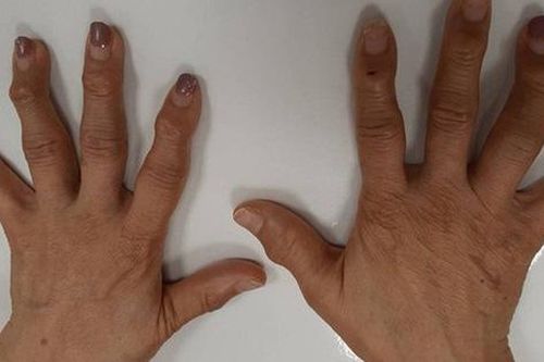 10 ngón tay đau nhức và biến dạng, người phụ nữ điếng người khi bác sĩ thông báo 'Không có thuốc chữa'