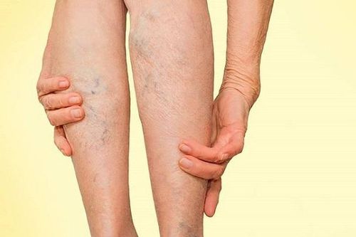 Phương pháp điều trị giãn tĩnh mạch chân
