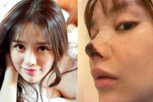 Bi kịch của những cô gái phẫu thuật thẩm mỹ hỏng