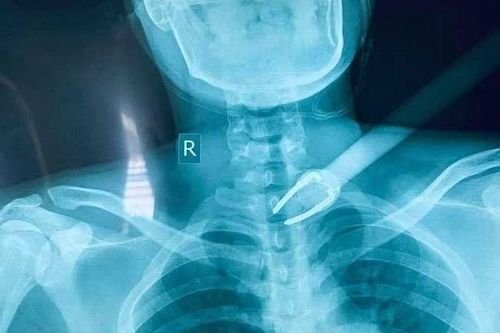 'Báo động đỏ' cứu sống nam sinh viên bị kẻ trộm bắn mũi tên xuyên cổ
