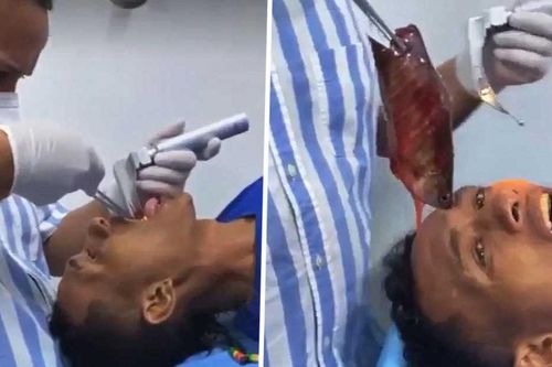 Chàng trai suýt chết vì con cá 18 cm kẹt trong cổ họng theo cách 'khó đỡ'