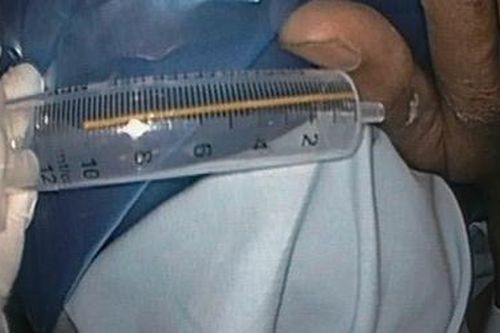 Nhập viện cận Tết vì tăm tre lọt vào đường tiêu hóa làm thủng tá tràng