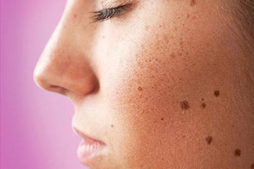 3 điều cần làm tốt để không bị đốm đồi mồi trên da